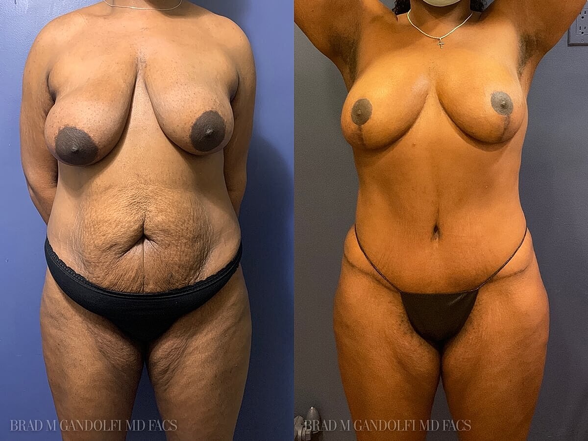 Tummy Tuck Before & After