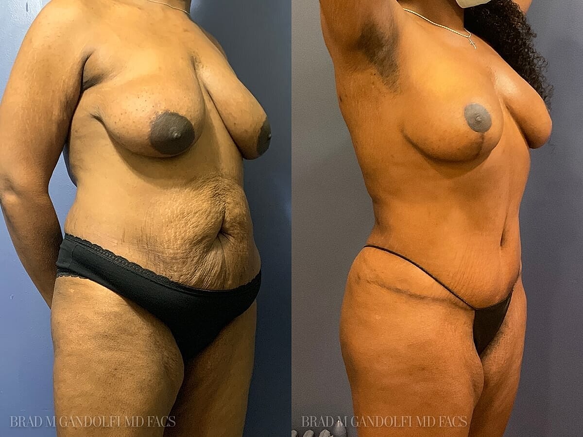 Tummy Tuck Before & After