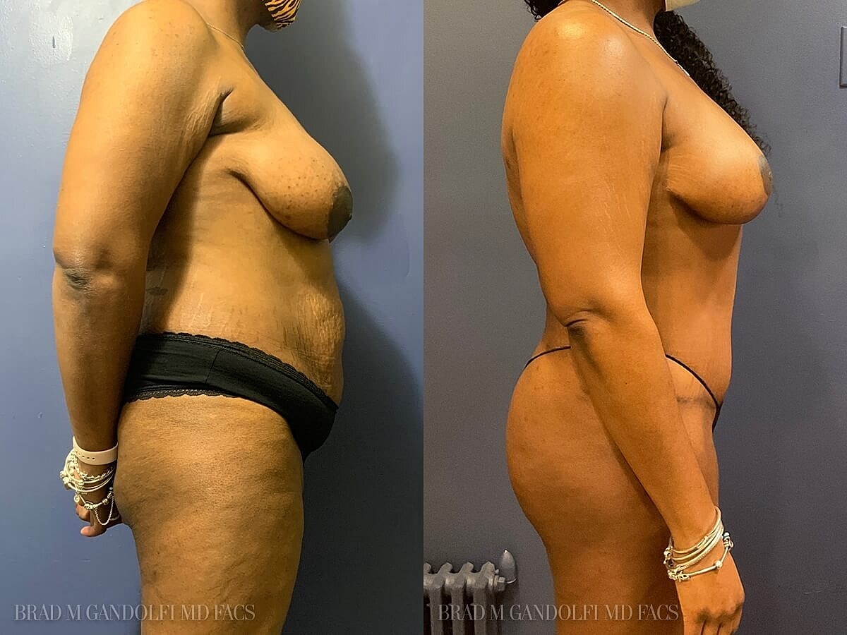 Tummy Tuck Before & After