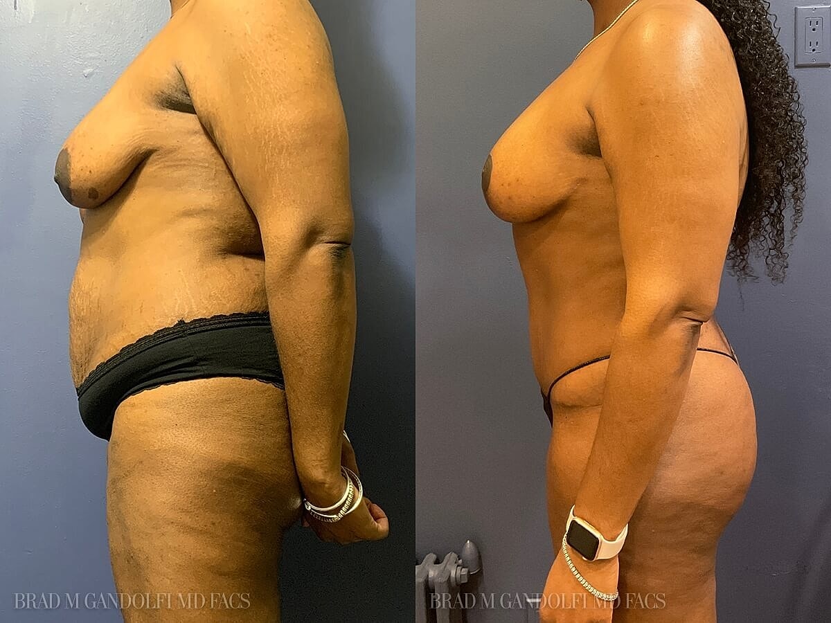 Tummy Tuck Before & After