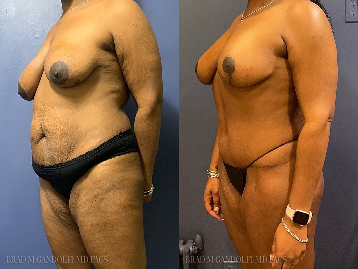 Tummy Tuck Before & After