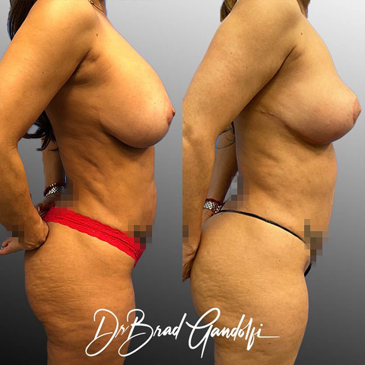 Tummy Tuck Before & After