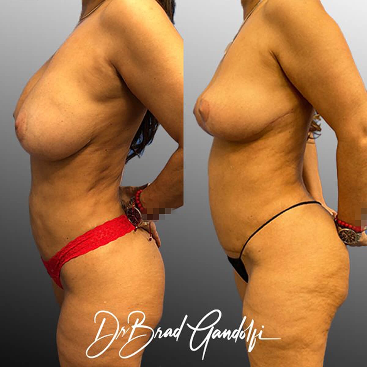 Tummy Tuck Before & After