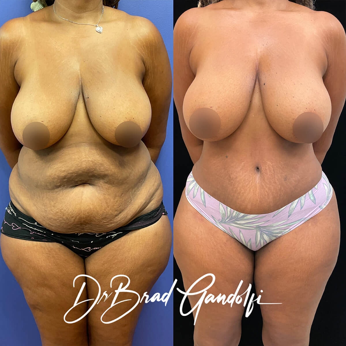 Tummy Tuck Before & After