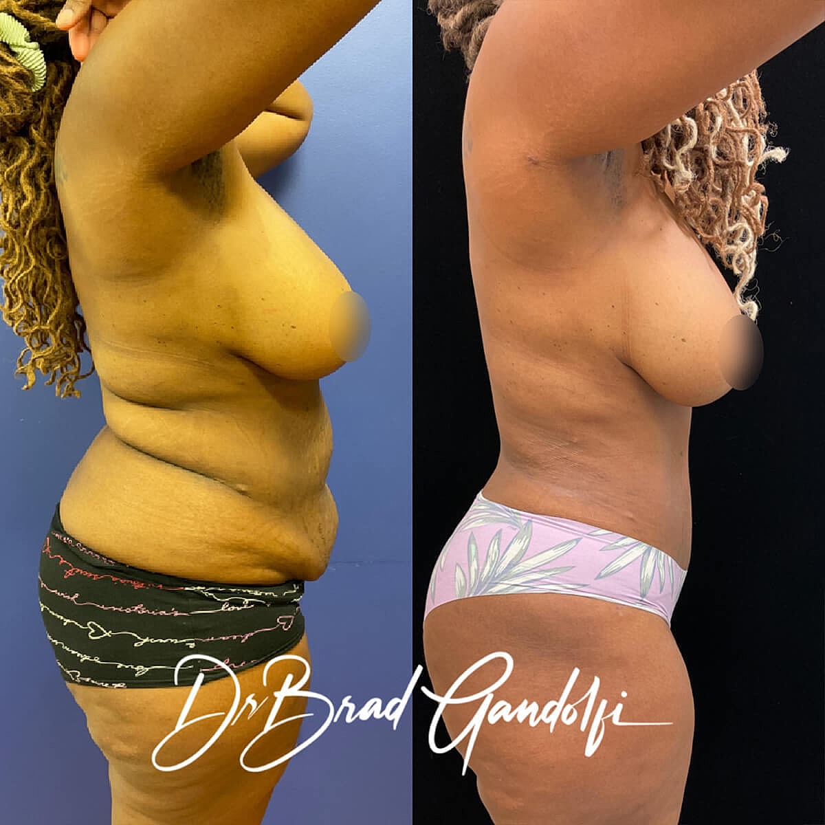Tummy Tuck Before & After