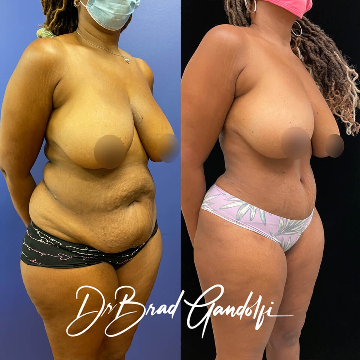 Tummy Tuck Before & After