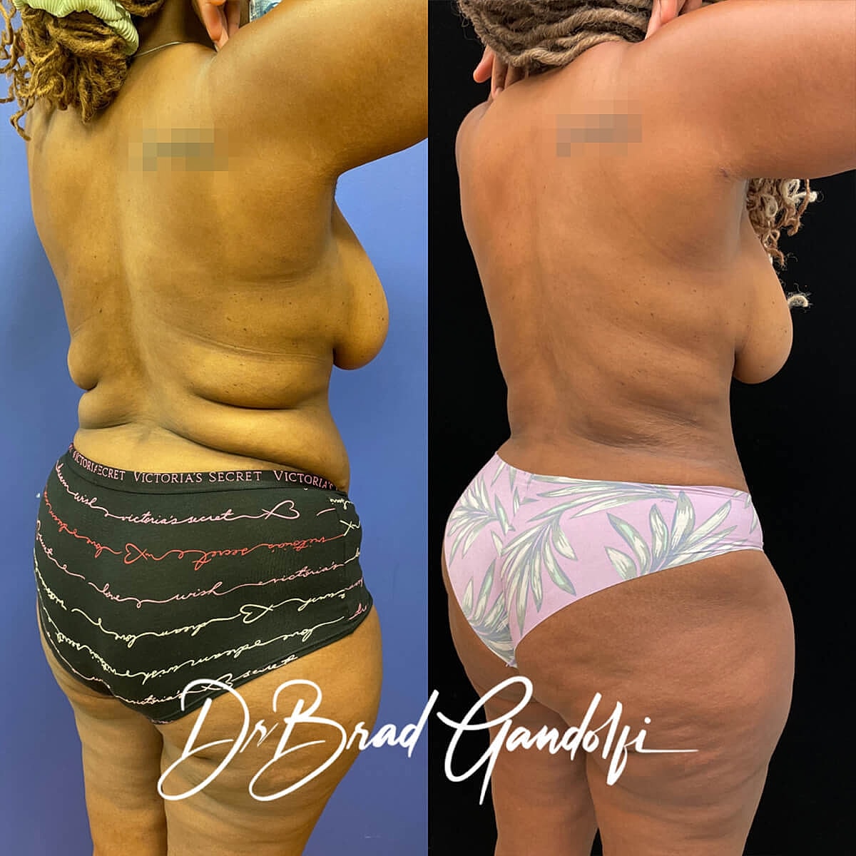 Tummy Tuck Before & After