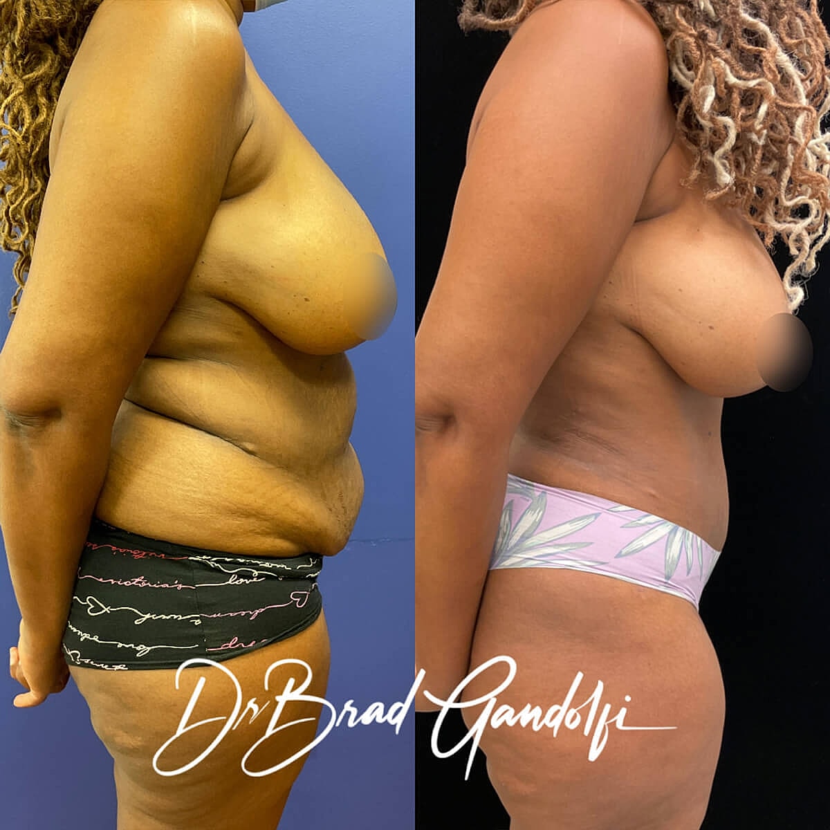 Tummy Tuck Before & After