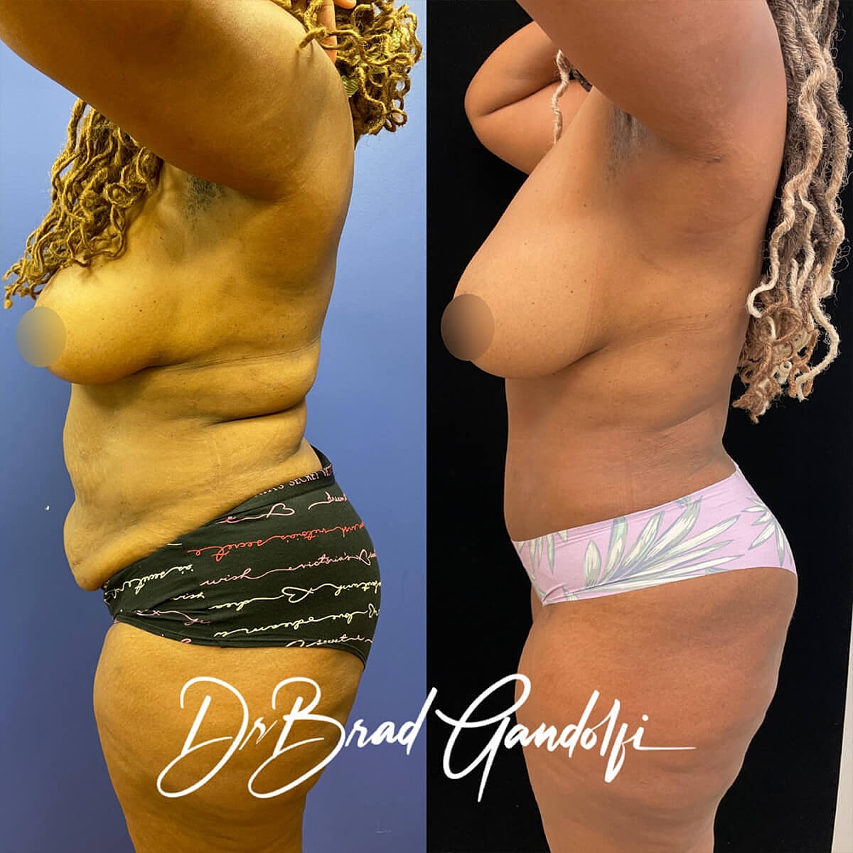 Tummy Tuck Before & After