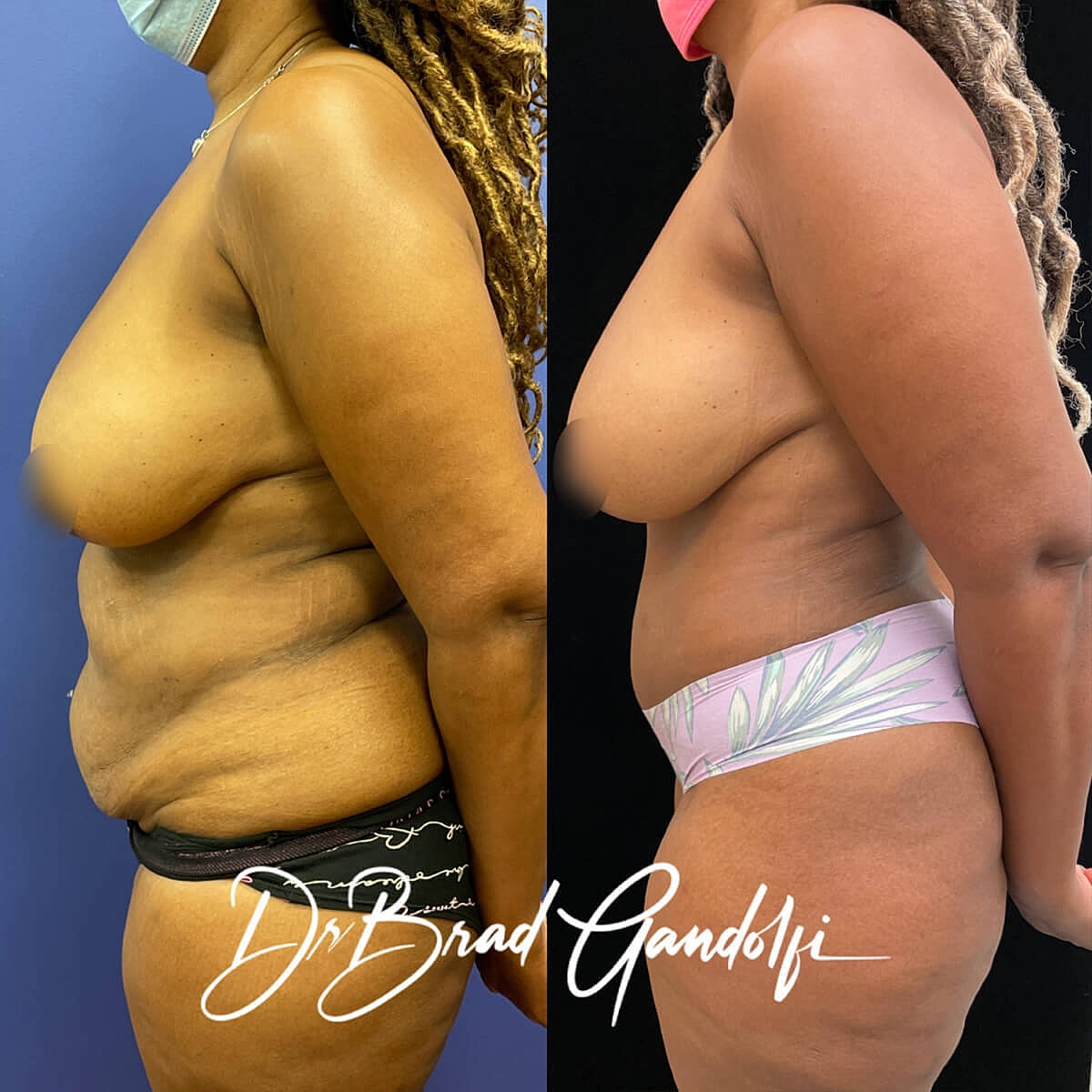 Tummy Tuck Before & After