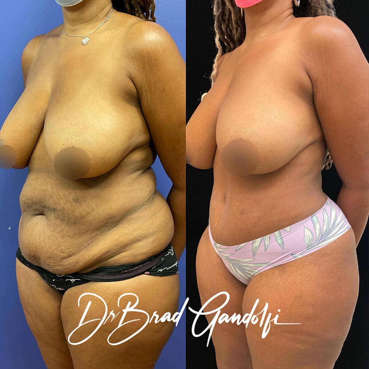 Tummy Tuck Before & After