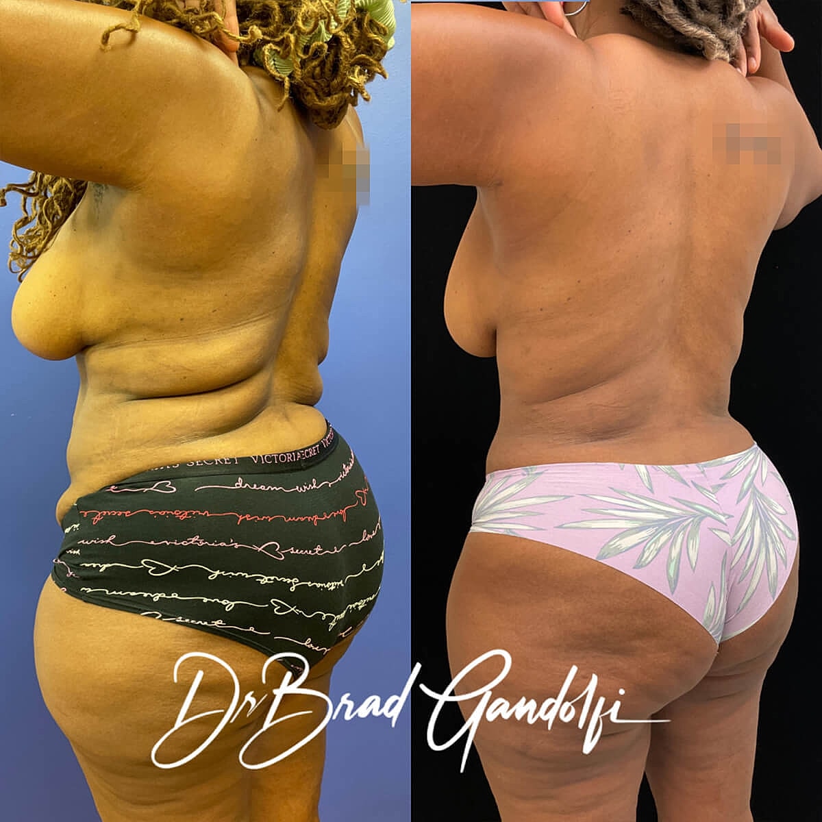 Tummy Tuck Before & After