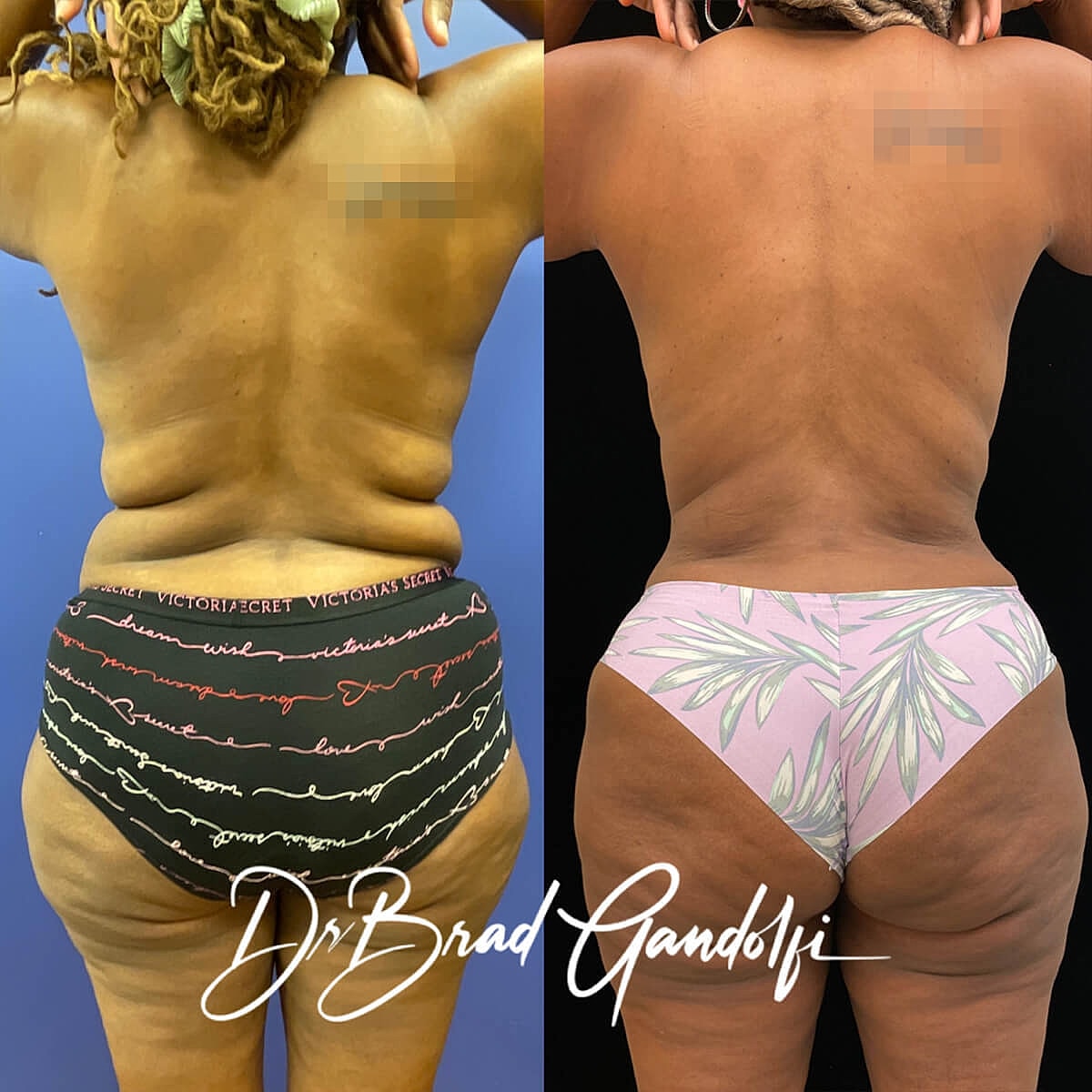 Tummy Tuck Before & After