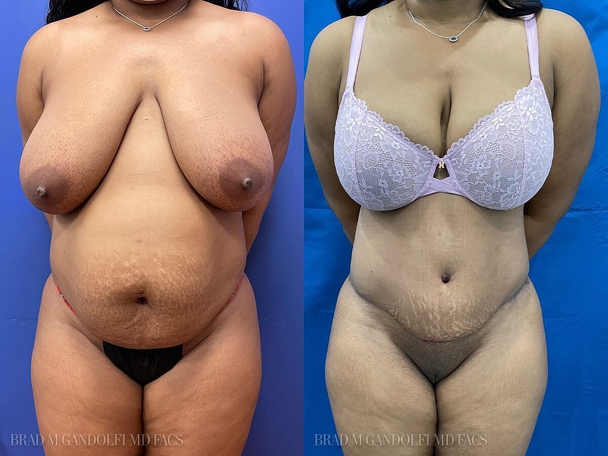 Tummy Tuck Before & After