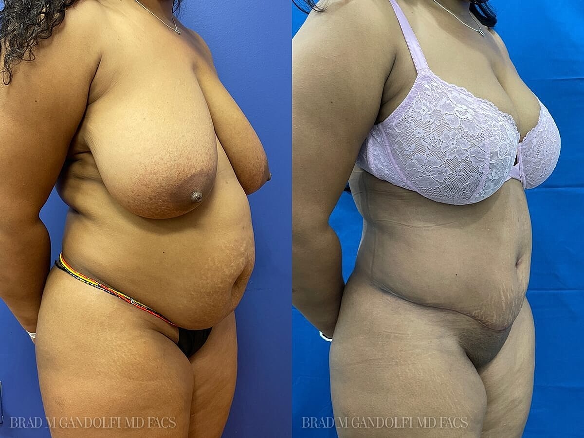 Tummy Tuck Before & After