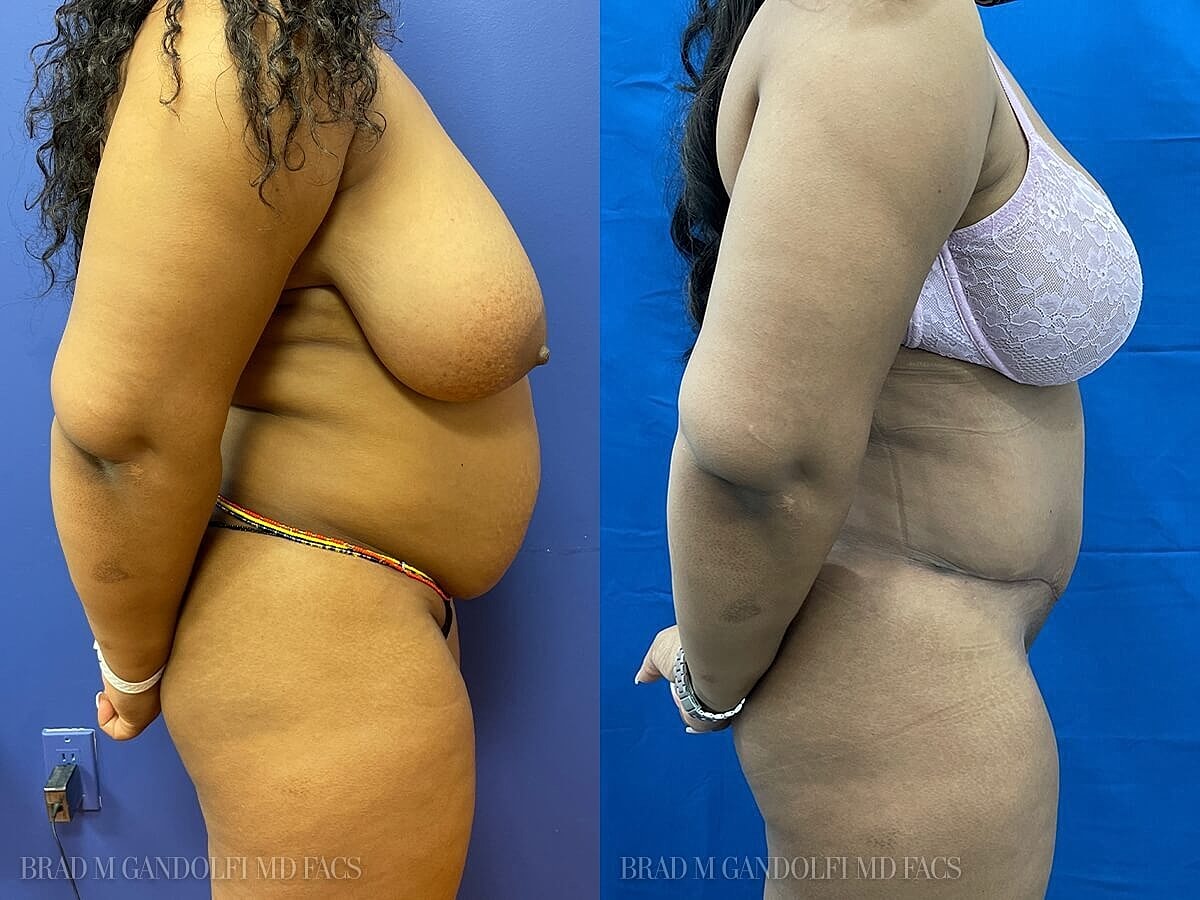 Tummy Tuck Before & After