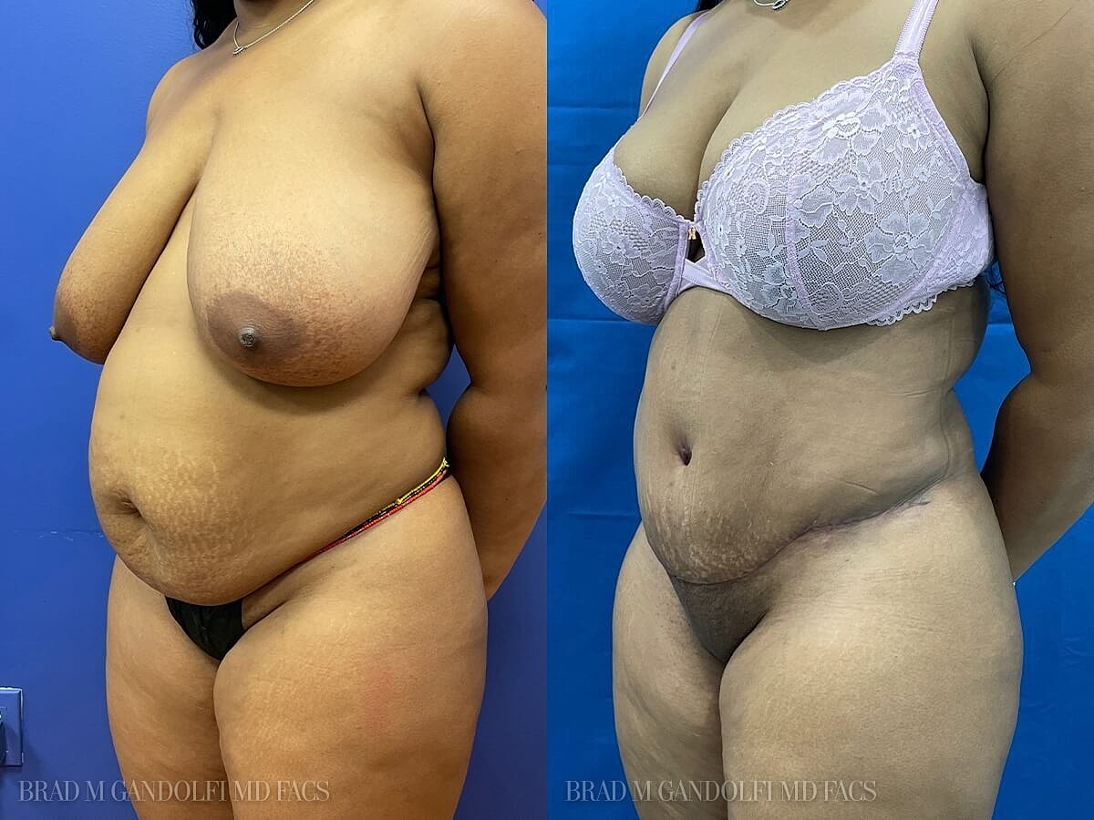 Tummy Tuck Before & After