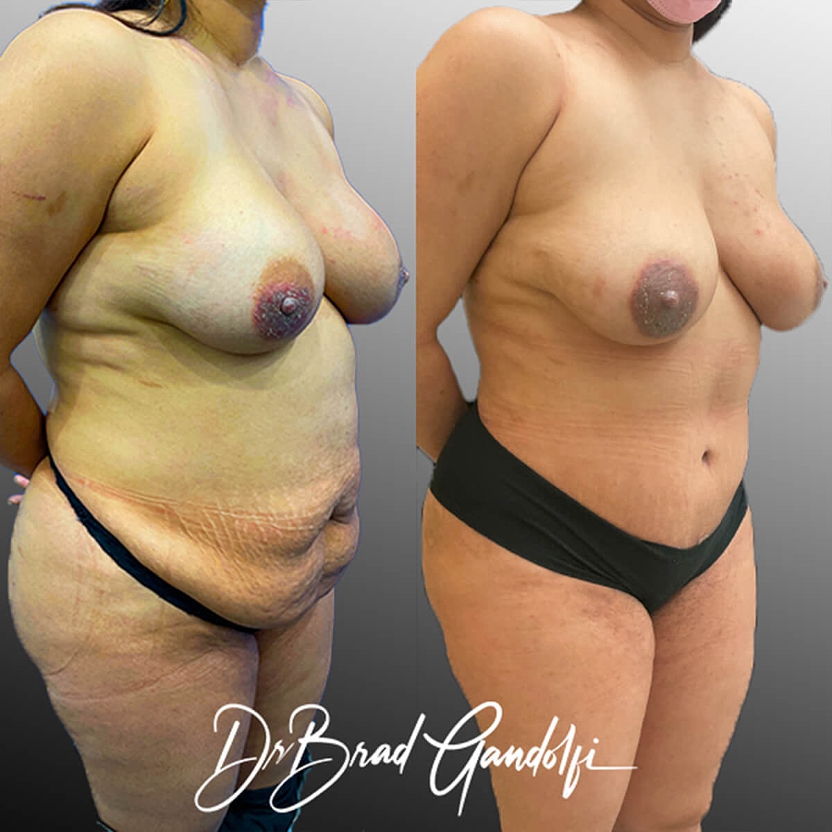 Tummy Tuck Before & After