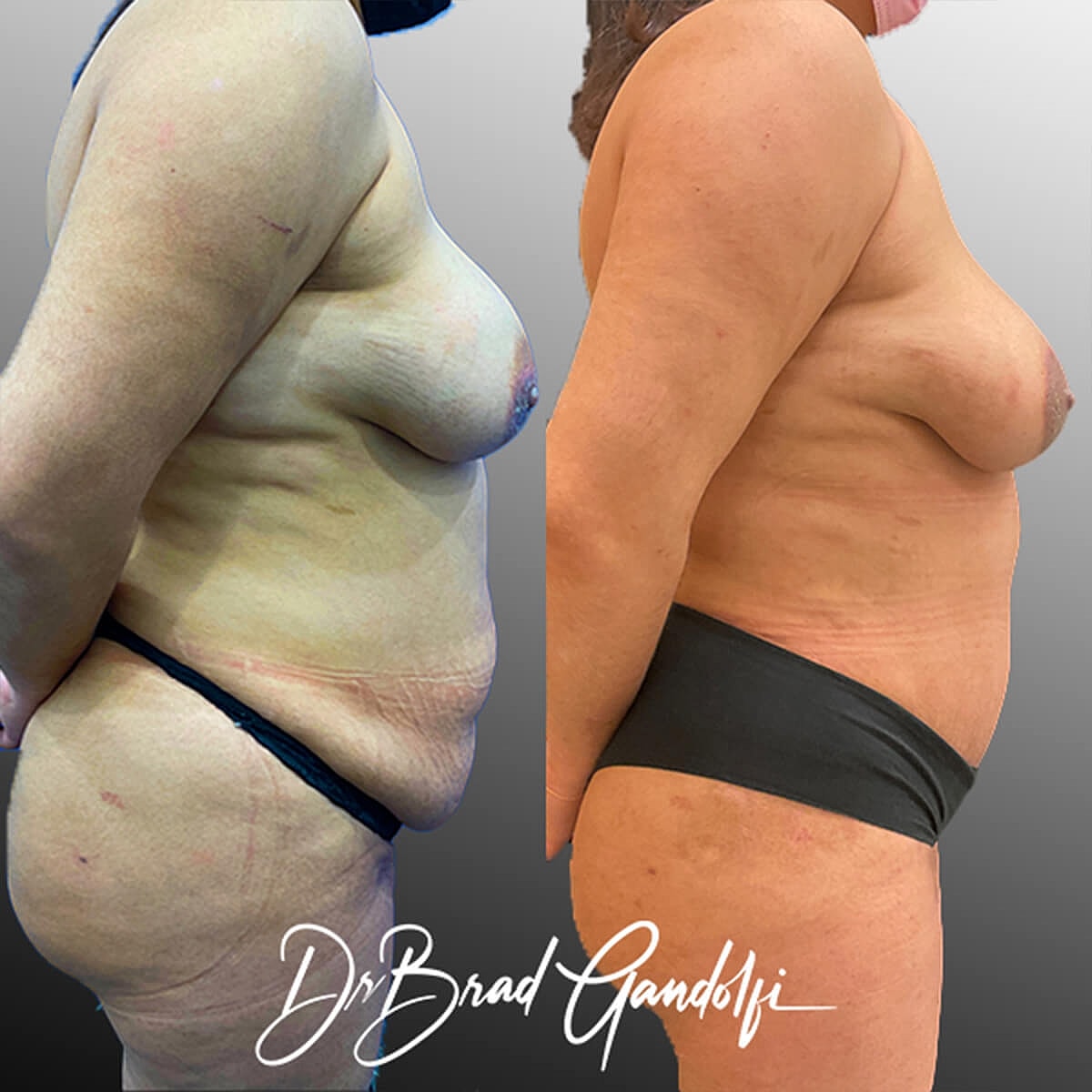 Tummy Tuck Before & After
