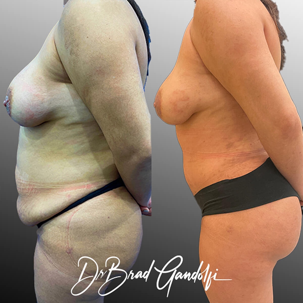 Tummy Tuck Before & After