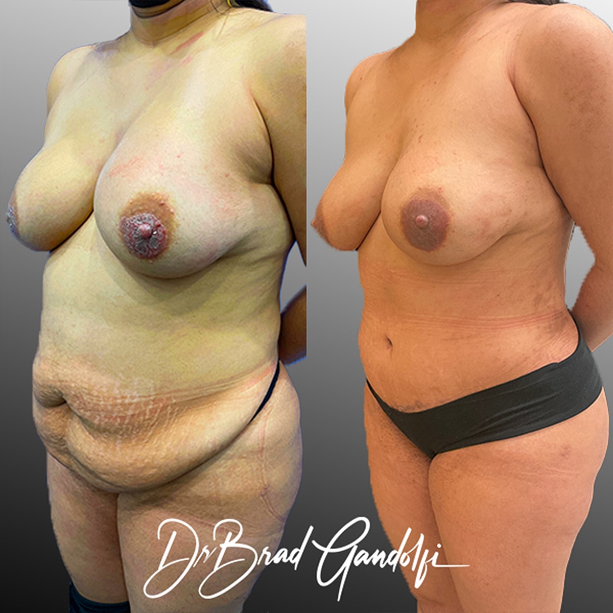 Tummy Tuck Before & After
