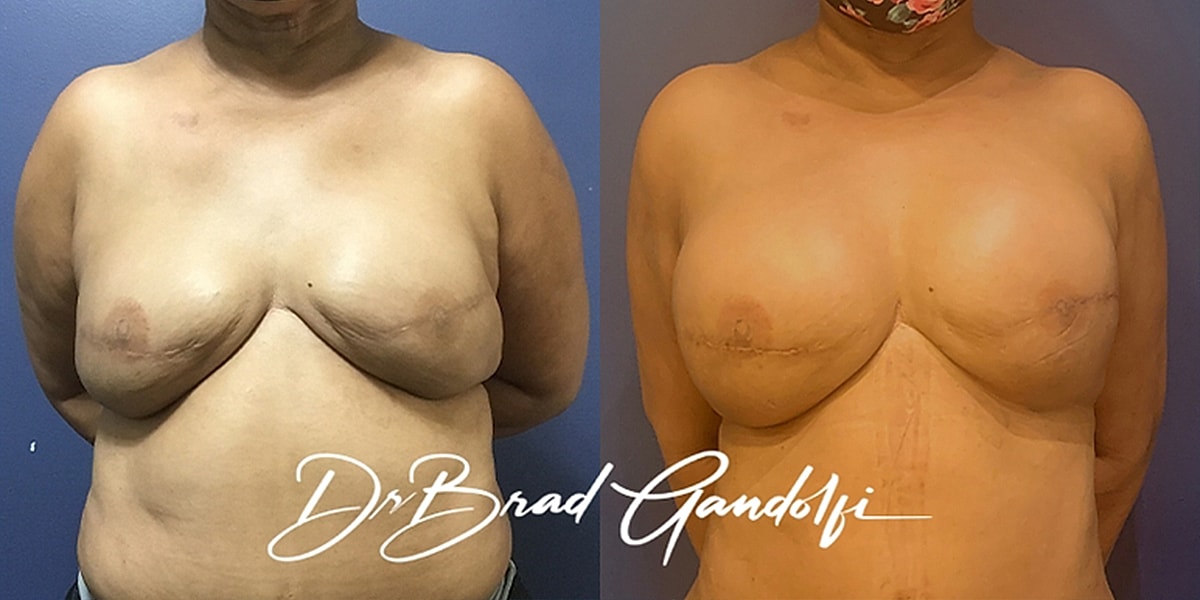 Breast Reconstruction Before & After