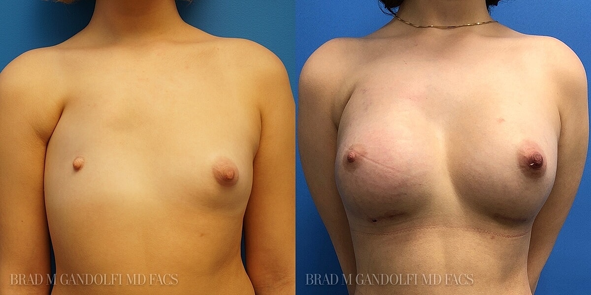 Breast Reconstruction Before & After