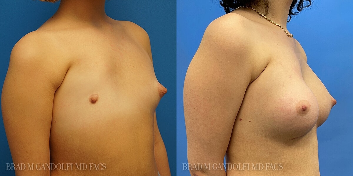 Breast Reconstruction Before & After