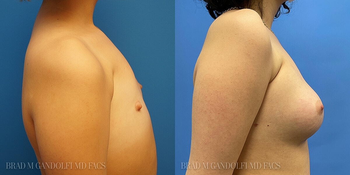Breast Reconstruction Before & After