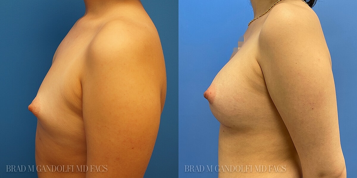 Breast Reconstruction Before & After