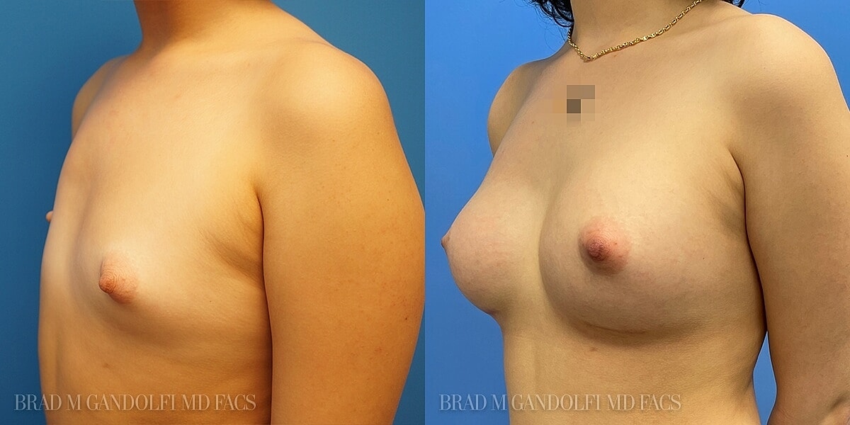 Breast Reconstruction Before & After