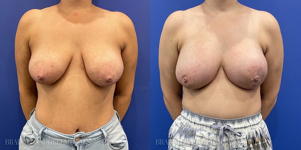 Breast Reconstruction Before & After