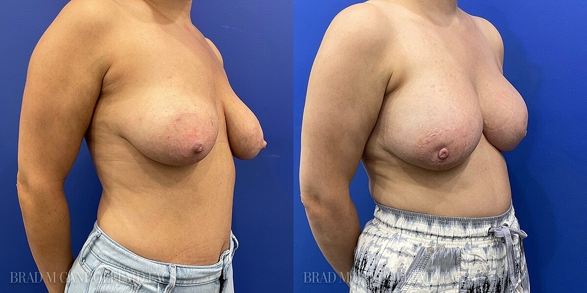Breast Reconstruction Before & After