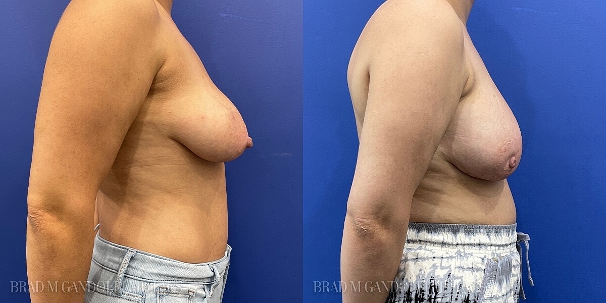 Breast Reconstruction Before & After