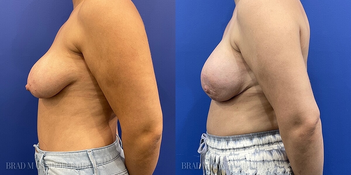 Breast Reconstruction Before & After