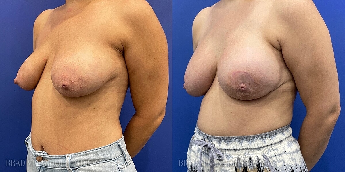 Breast Reconstruction Before & After
