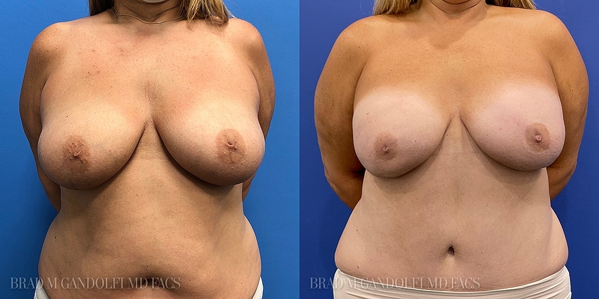 Breast Reconstruction Before & After