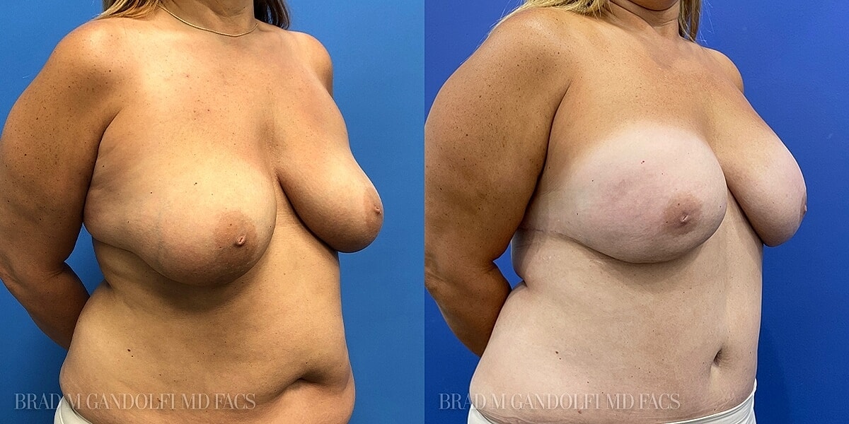 Breast Reconstruction Before & After
