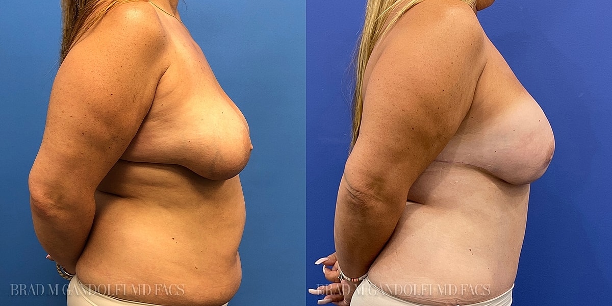 Breast Reconstruction Before & After