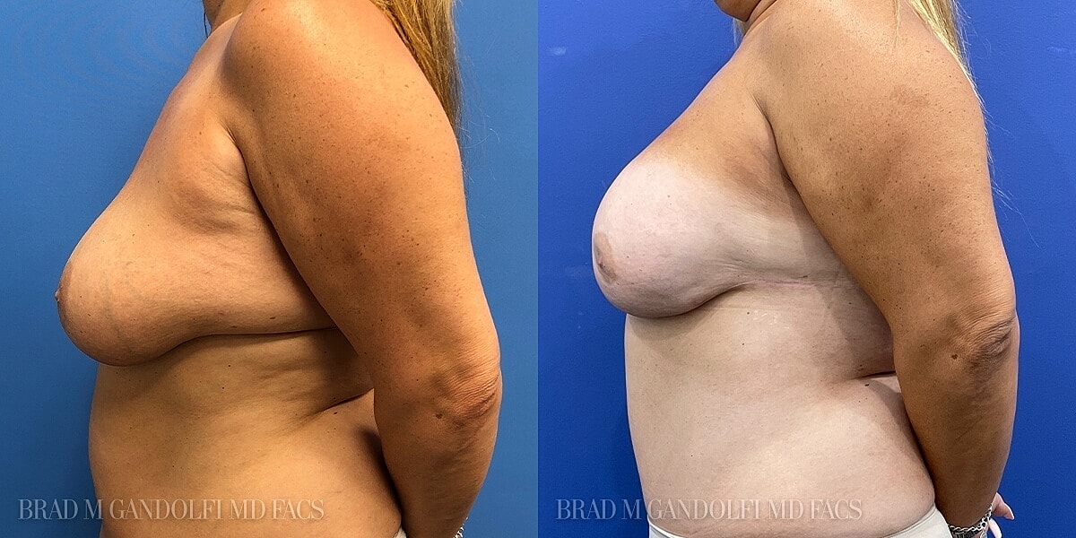 Breast Reconstruction Before & After