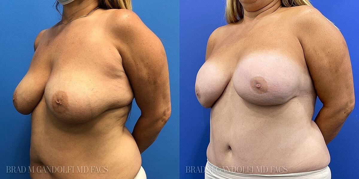 Breast Reconstruction Before & After