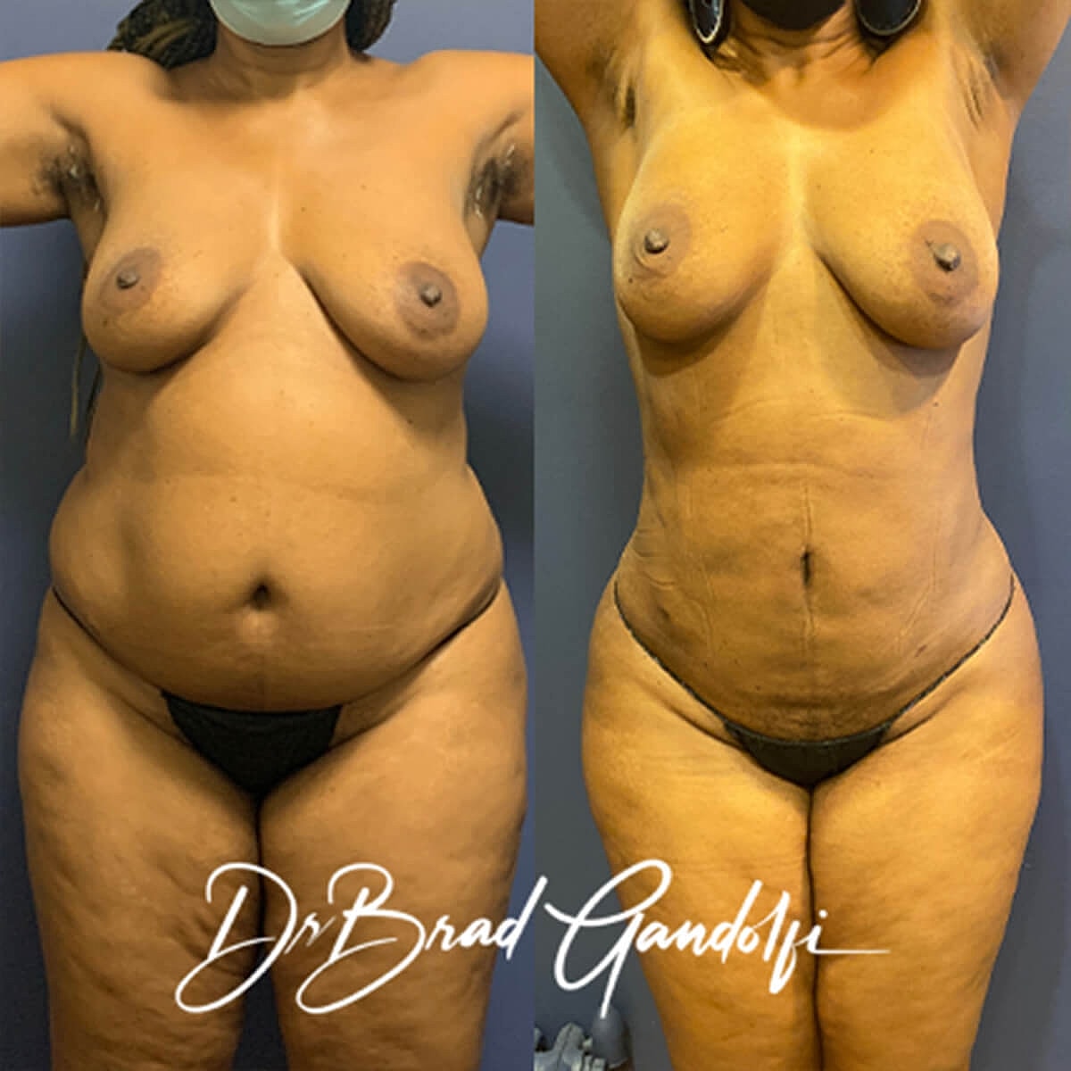 Mommy Makeover Before & After