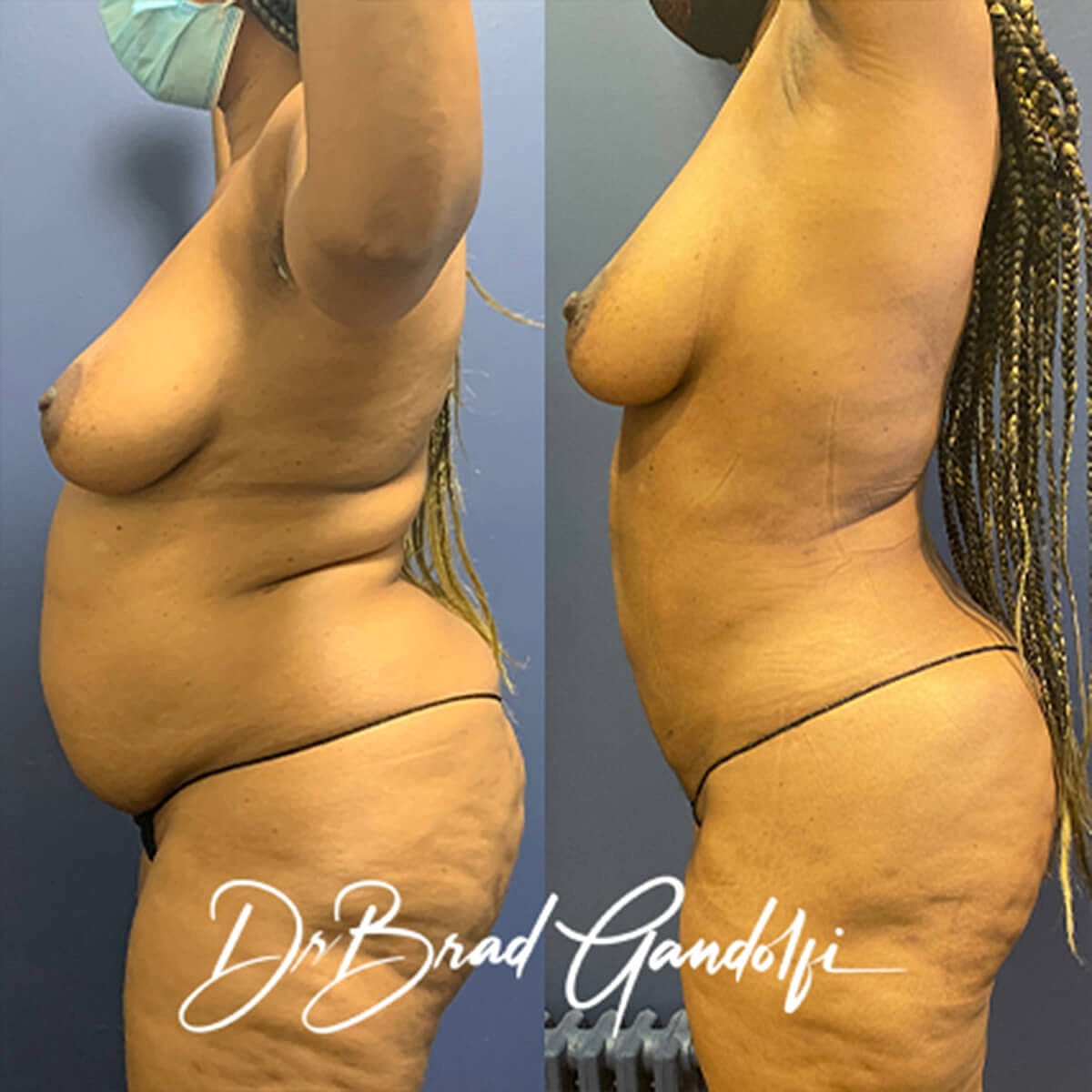 Mommy Makeover Before & After