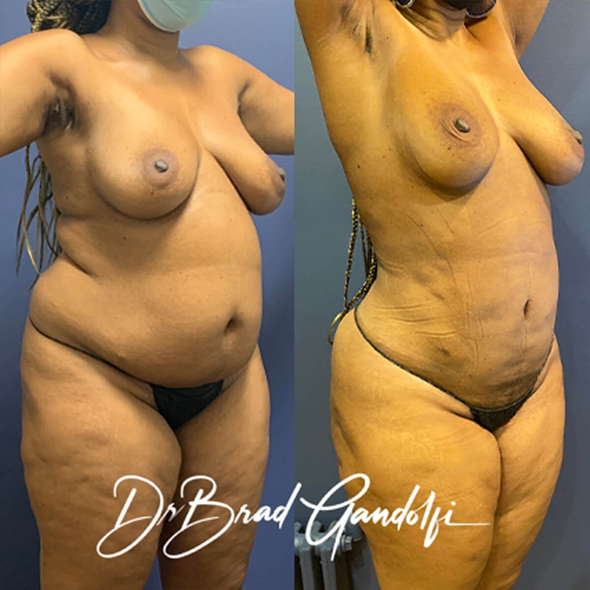 Mommy Makeover Before & After