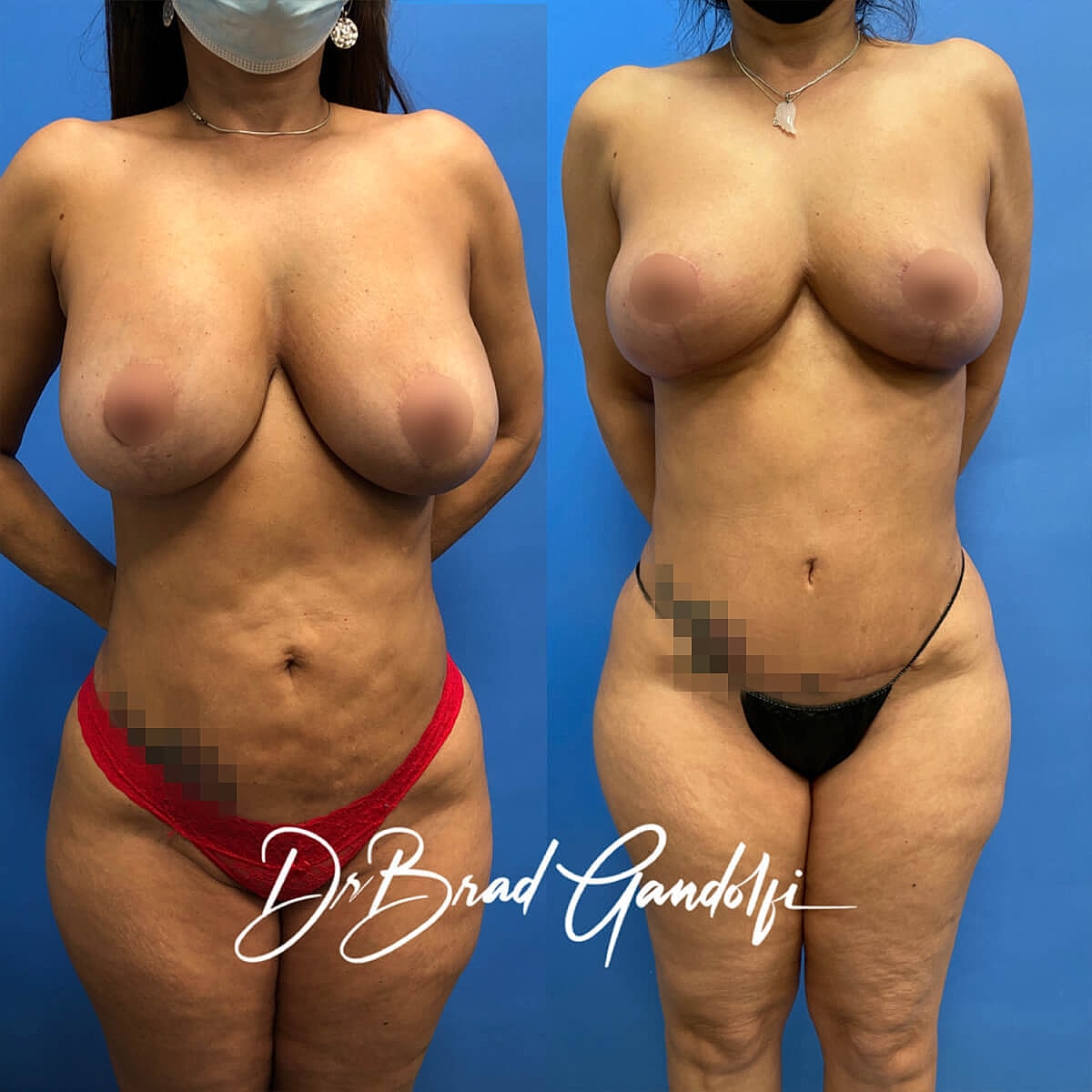 Mommy Makeover Before & After
