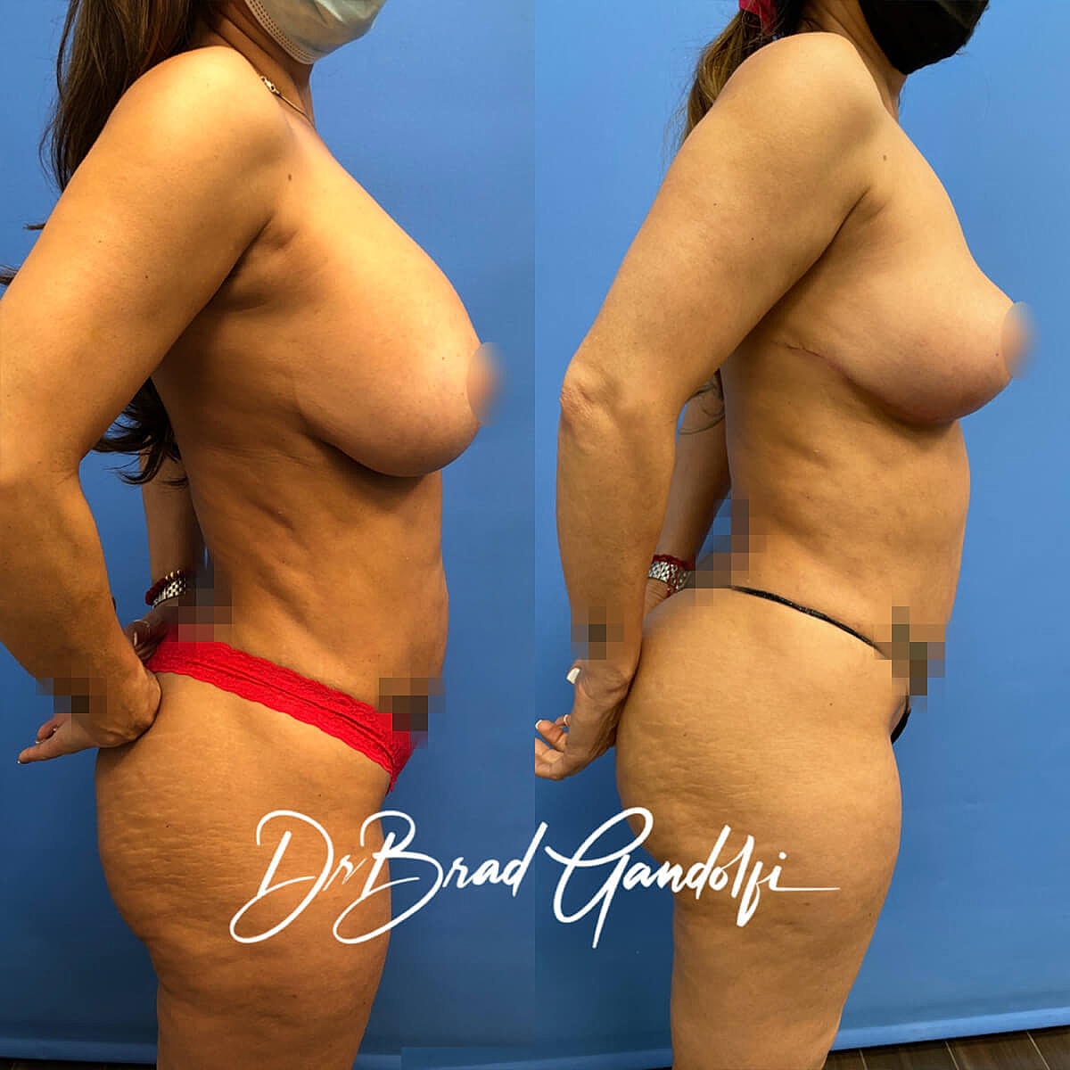 Mommy Makeover Before & After