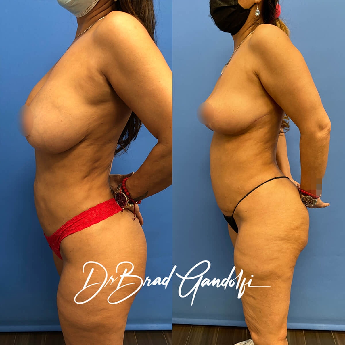 Mommy Makeover Before & After
