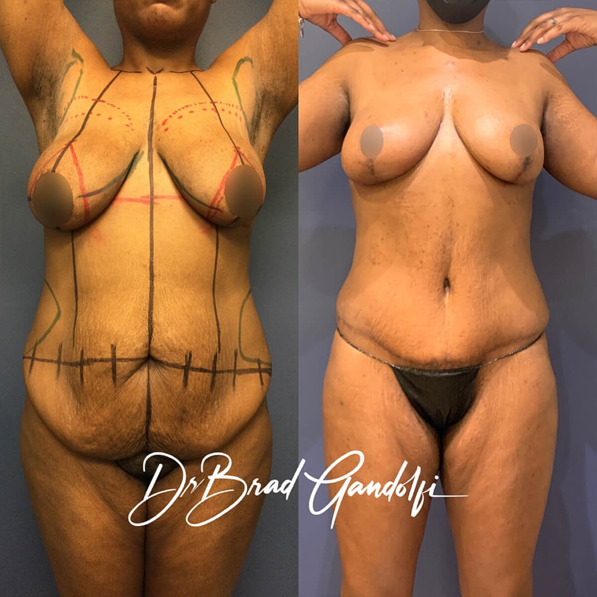 Mommy Makeover Before & After
