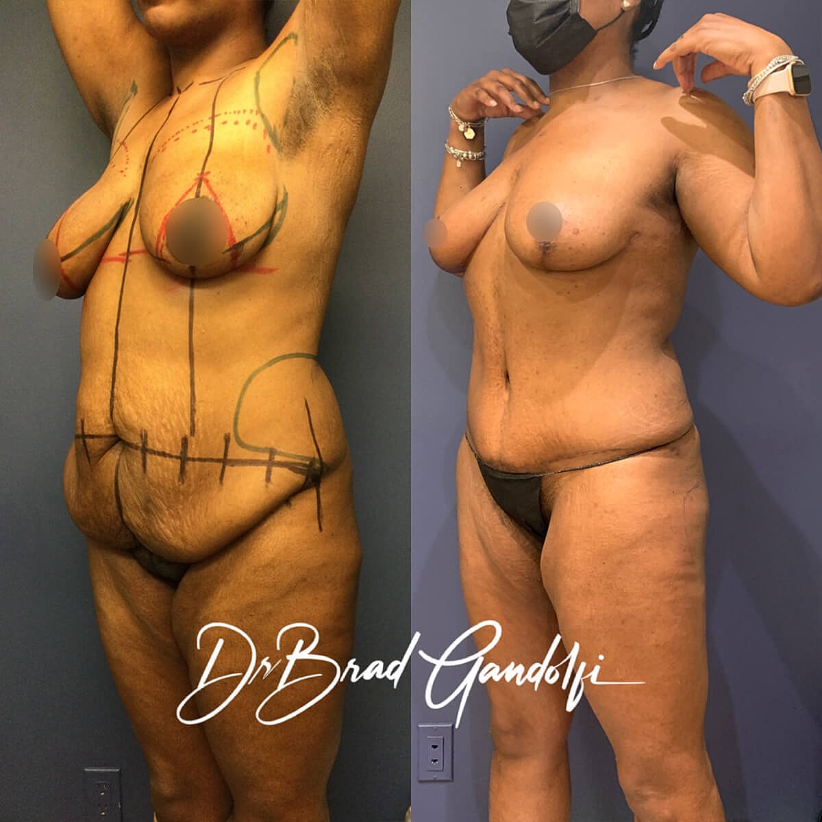 Mommy Makeover Before & After