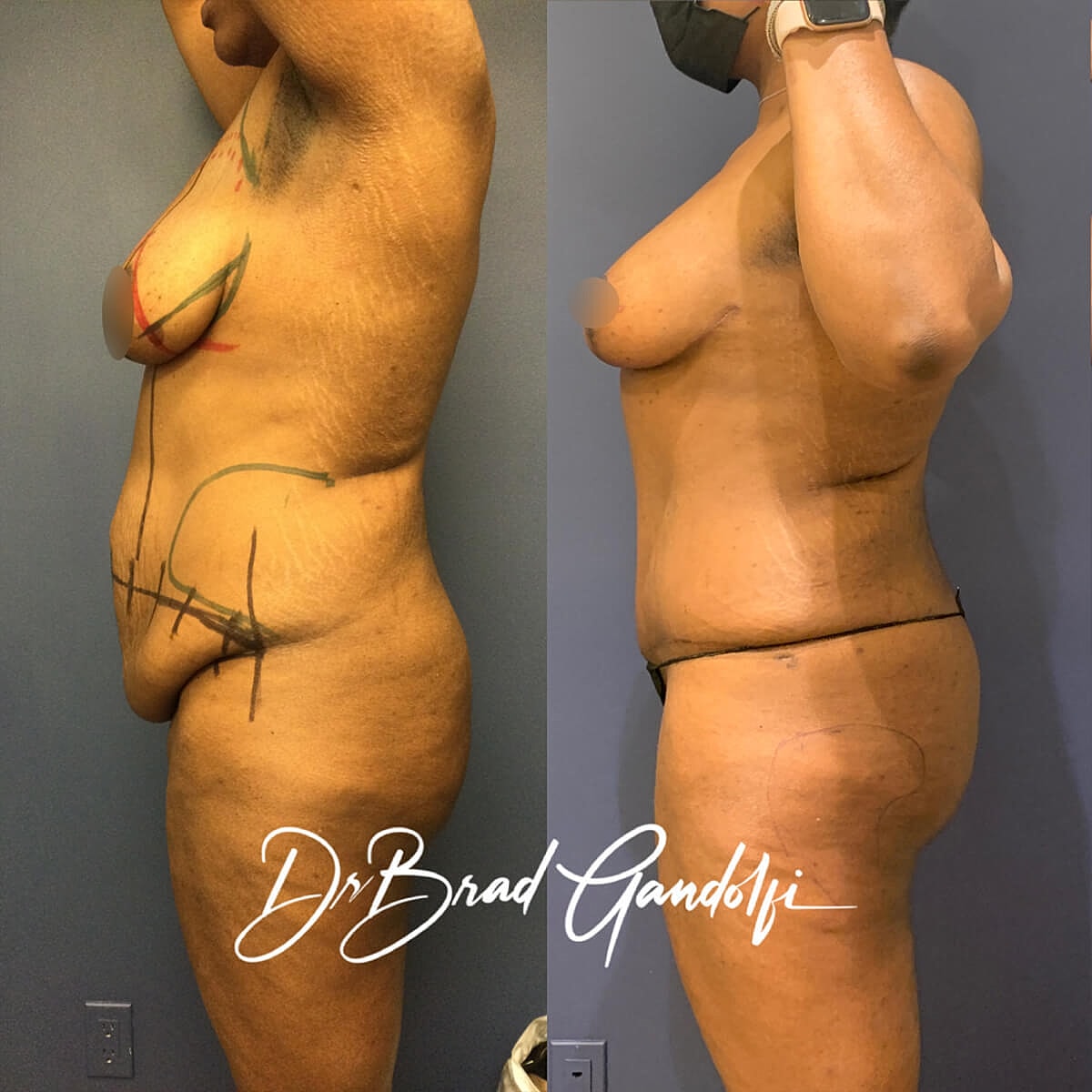 Mommy Makeover Before & After